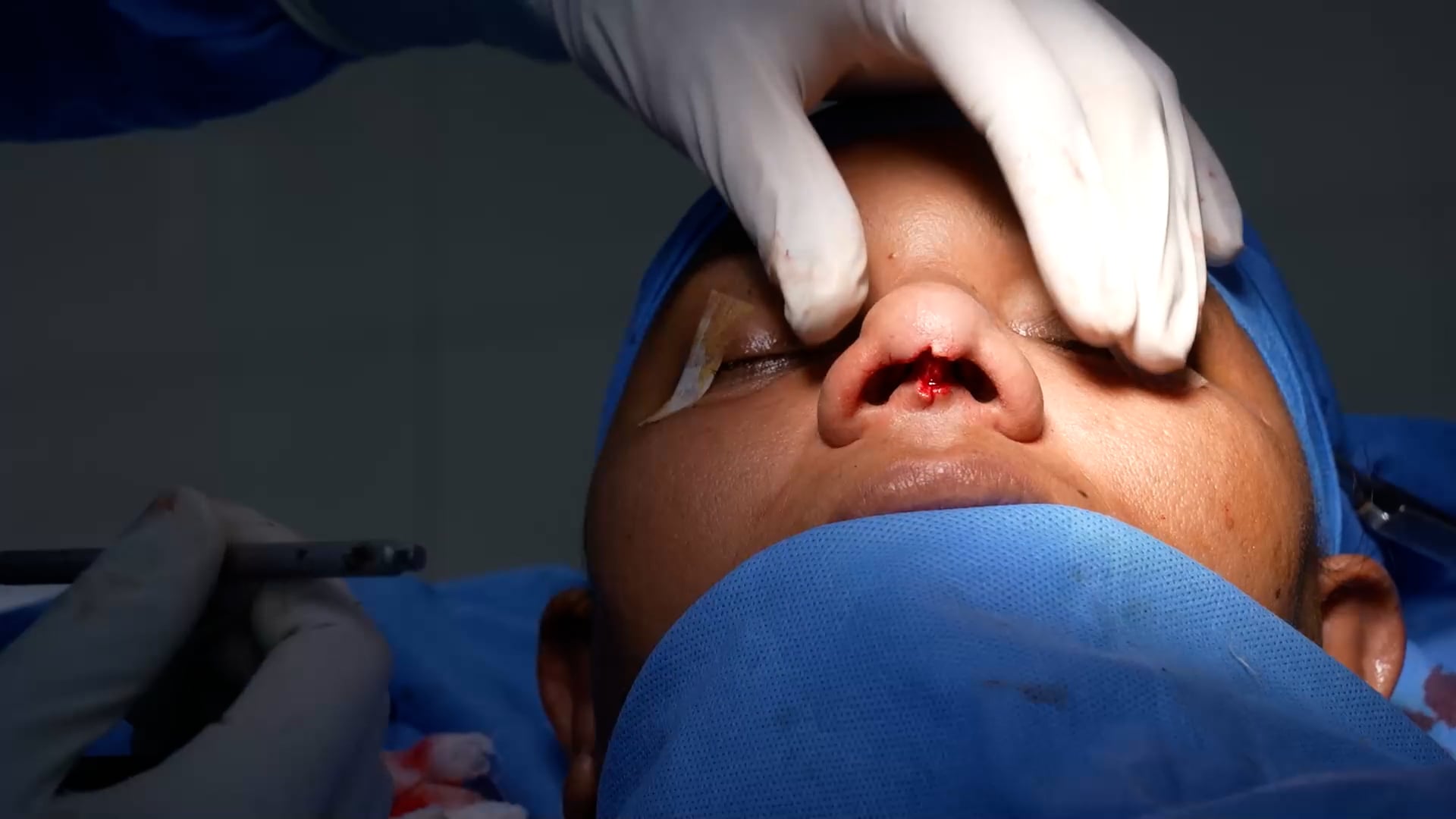 Open structure rhinoplasty with rib grafting